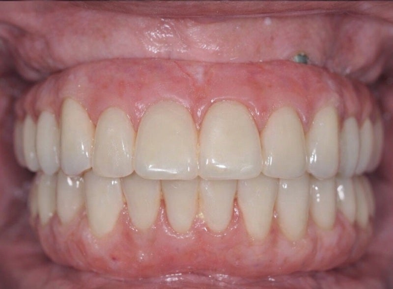 full_mouth_dental_implant_after