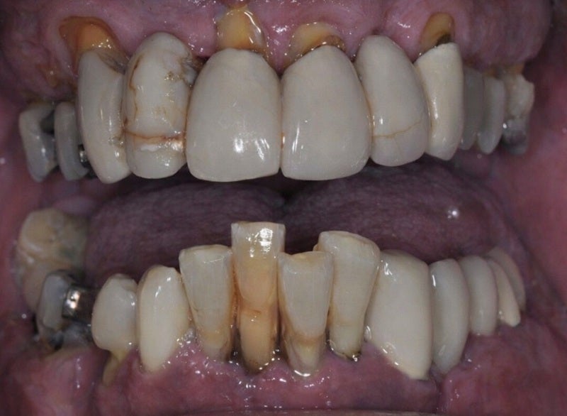 full_mouth_dental_implant_before