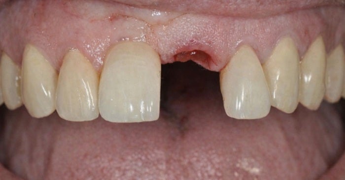 Implant_Before