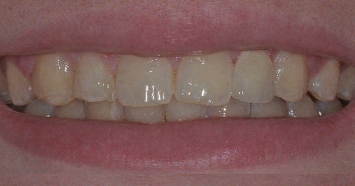 single_tooth_implant_after