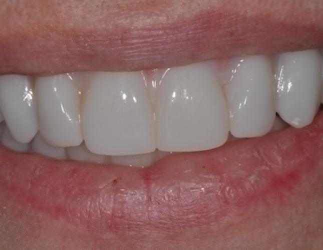 All-on-4 Dental Implants 1 after All-on-4 Dental Implants 1 after