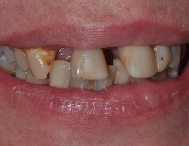 All-on-4 Dental Implants 1 All-on-4 Dental Implants 1