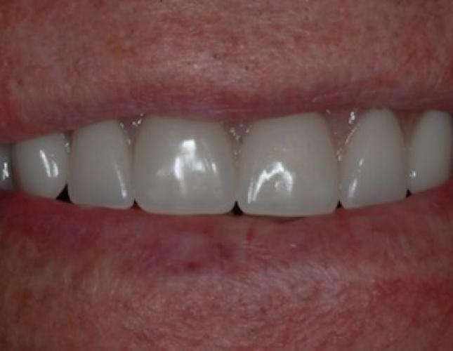 All-on-4 Dental Implants 2 after All-on-4 Dental Implants 2 after