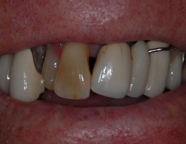 All-on-4 Dental Implants 2 All-on-4 Dental Implants 2