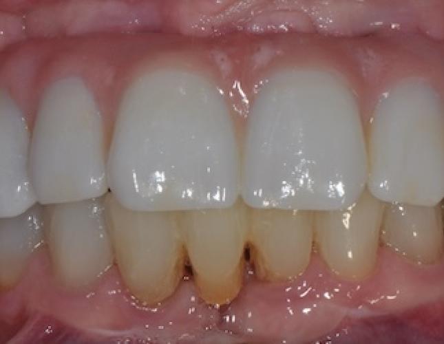 All-on-4 Dental Implants 3 after