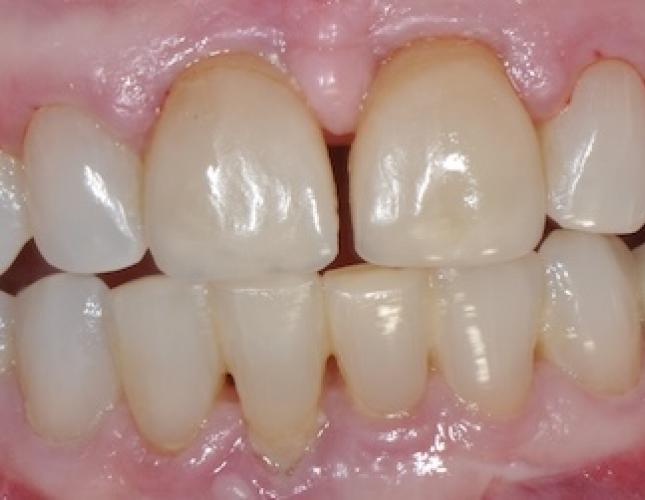 All-on-4 Dental Implants 3
