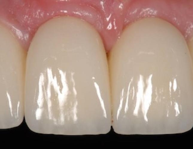 Anterior Implant Bridge after