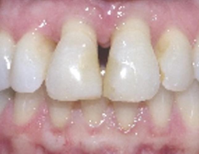 Anterior Implant Bridge