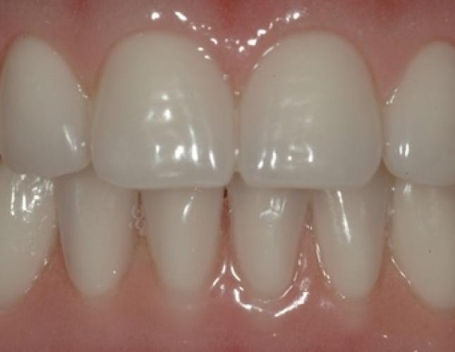 Implants for Removable Dentures 1 after