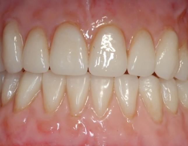 Implants for Removable Dentures 2 after