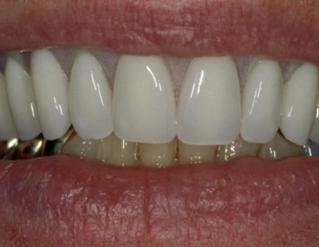 Implants for Removable Dentures 3 after