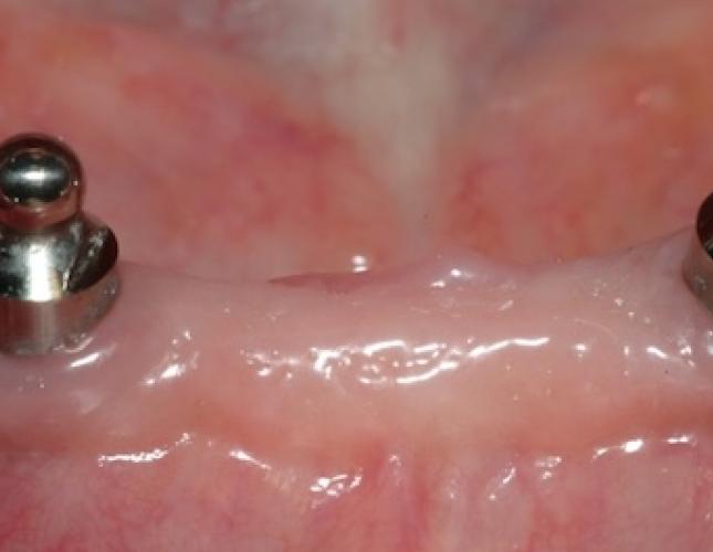 Implants for Removable Dentures 1
