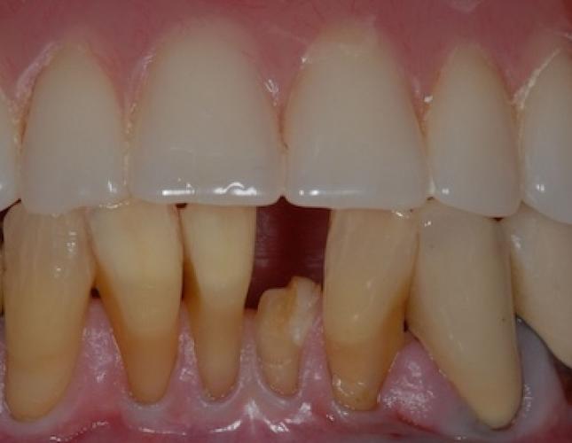 Implants for Removable Dentures 2