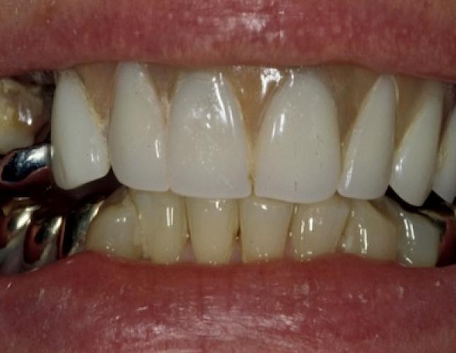 Implants for Removable Dentures 3