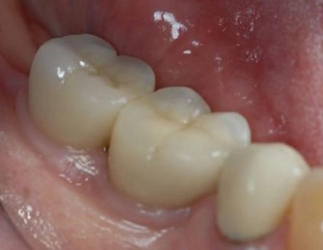 Implants to Replace Missing Back Teeth 1 After