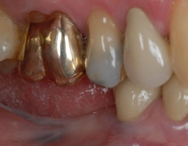 Implants to Replace Missing Back Teeth 1