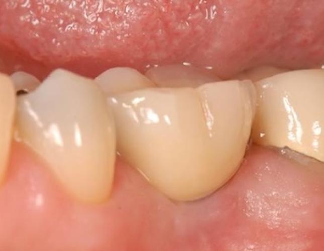Implants to Replace Missing Back Teeth 2 after