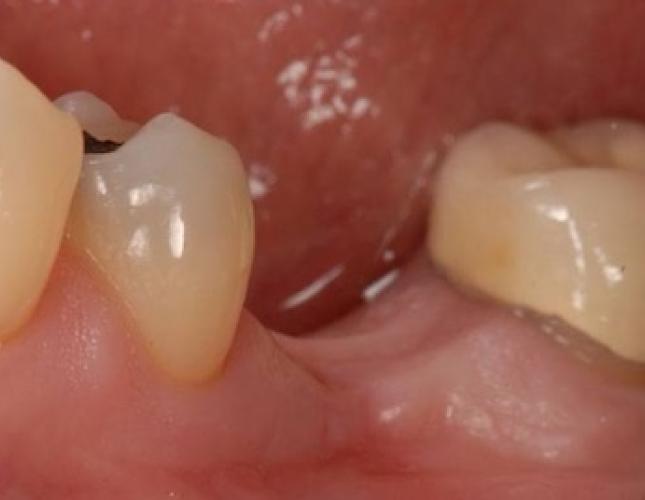 Implants to Replace Missing Back Teeth 2