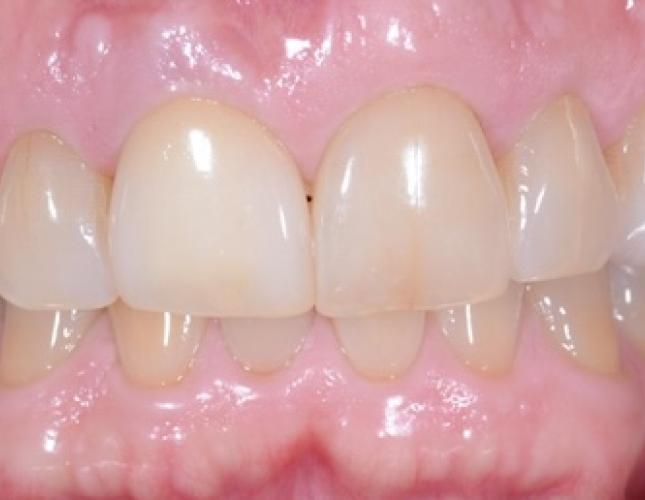 Single Tooth Implant 1 after