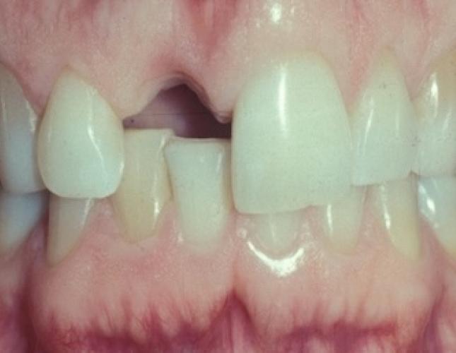 Single Tooth Implant 1