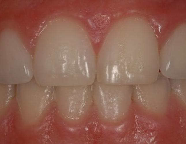 Single Tooth Implant 2 after