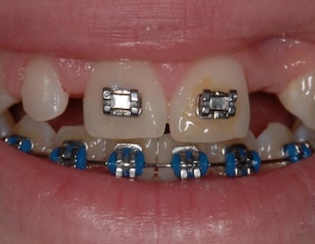 Single Tooth Implant 2
