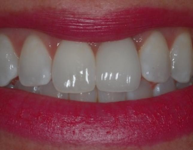 Single Tooth Implant 3 after