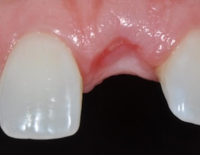 Single Tooth Implant 3