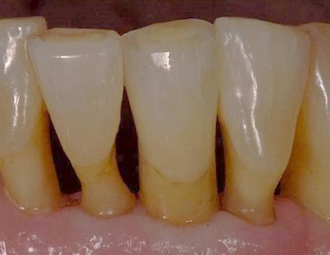 Single Tooth Implant 4 after