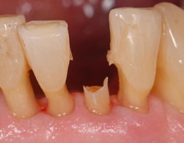 Single Tooth Implant 4