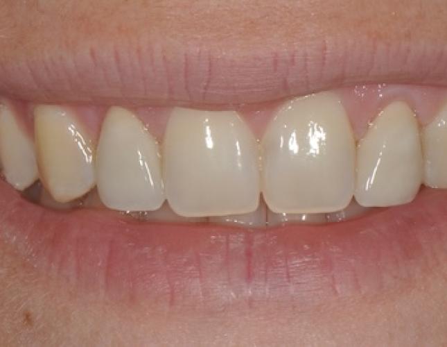 Esthetic Gum Lift after