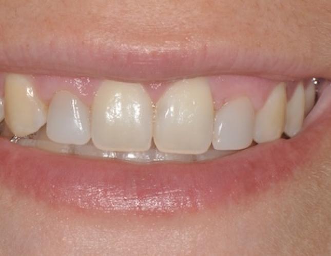 Esthetic Gum Lift before