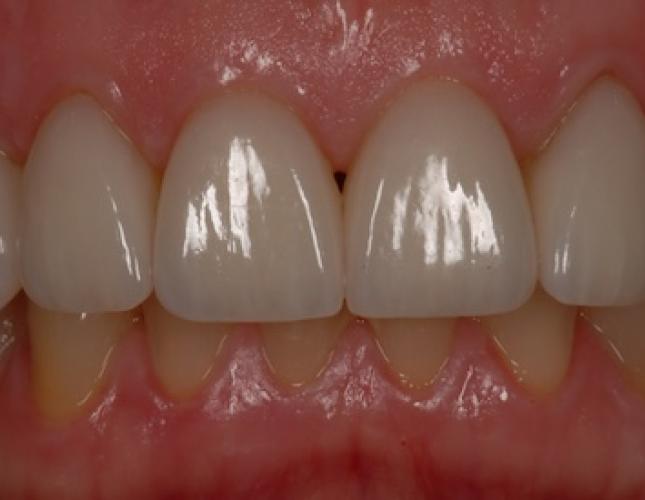 Porcelain Veneers after