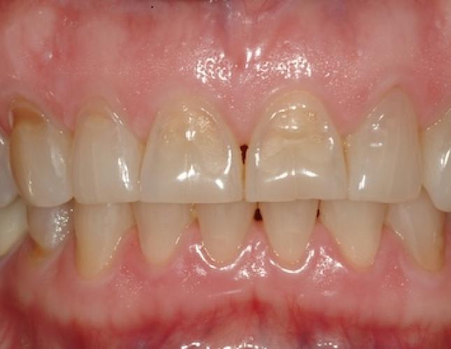 Porcelain Veneers before