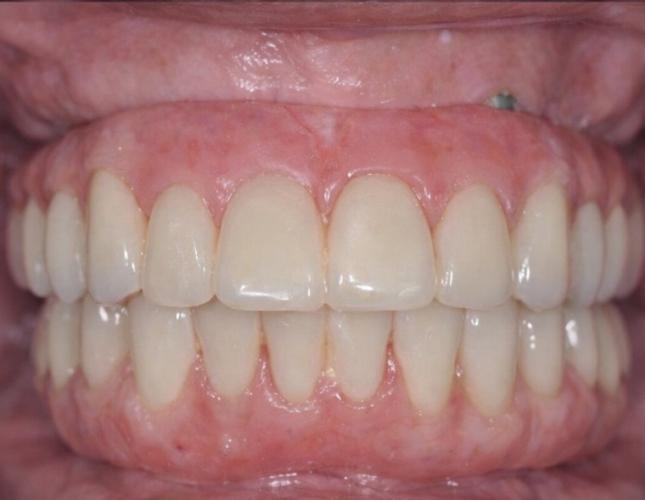 full_mouth_dental_implant_after