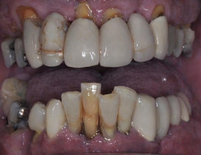 full_mouth_dental_implant_before