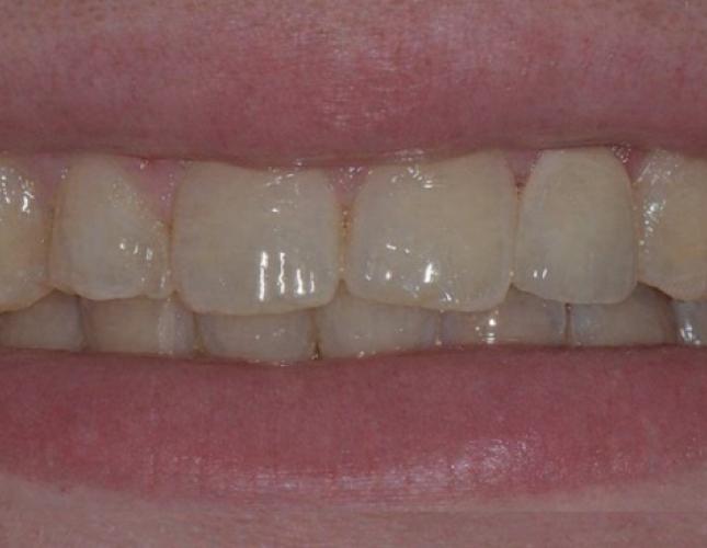 single_tooth_implant_after