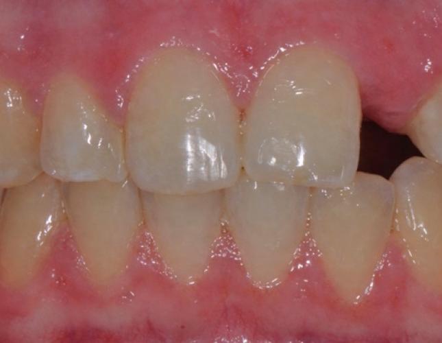 single_tooth_implant_before